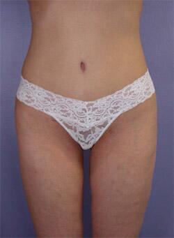 Liposuction Before & After Image