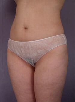 Liposuction Before & After Image