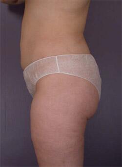 Liposuction Before & After Image