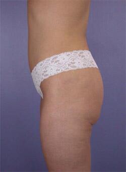 Liposuction Before & After Image