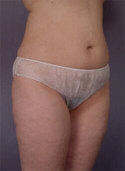 Liposuction Before & After Image