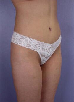 Liposuction Before & After Image