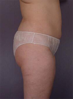 Liposuction Before & After Image