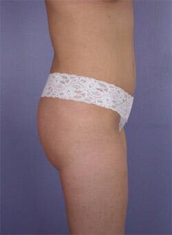 Liposuction Before & After Image