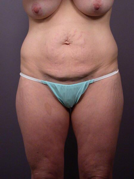 Liposuction Before & After Image