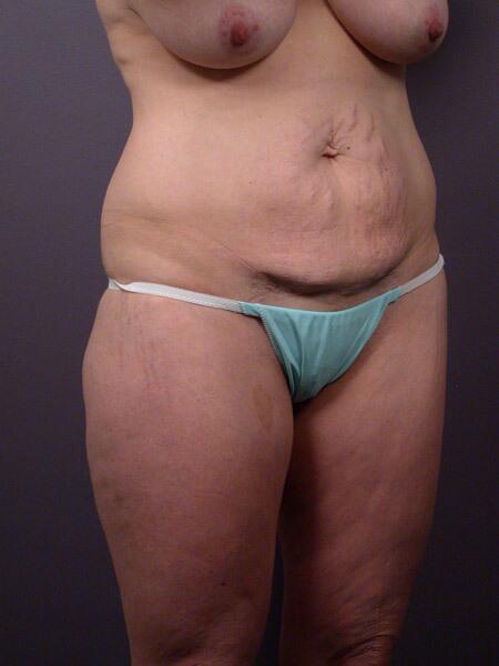 Liposuction Before & After Image