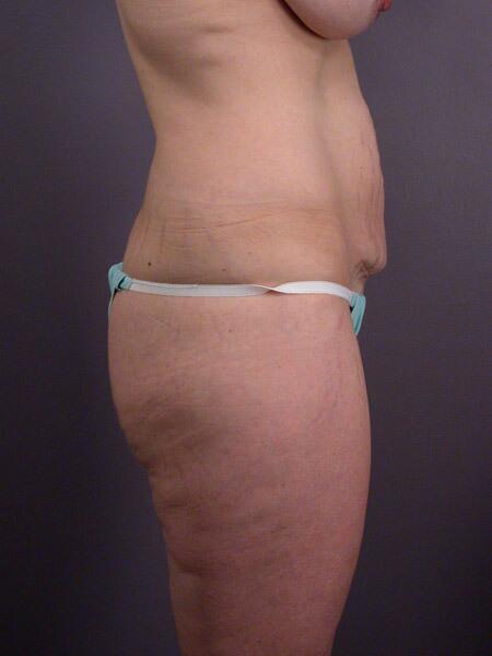 Liposuction Before & After Image