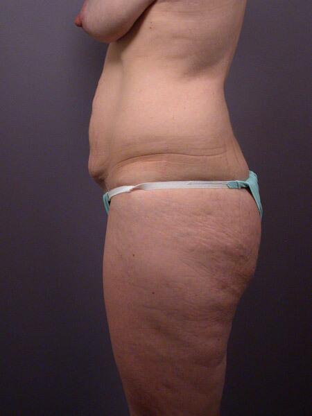 Liposuction Before & After Image