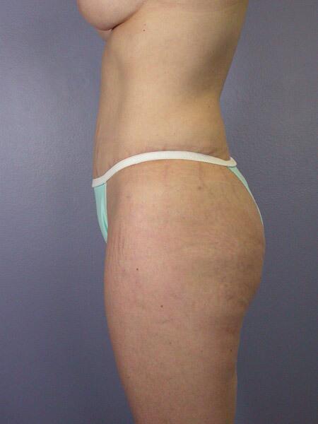 Liposuction Before & After Image