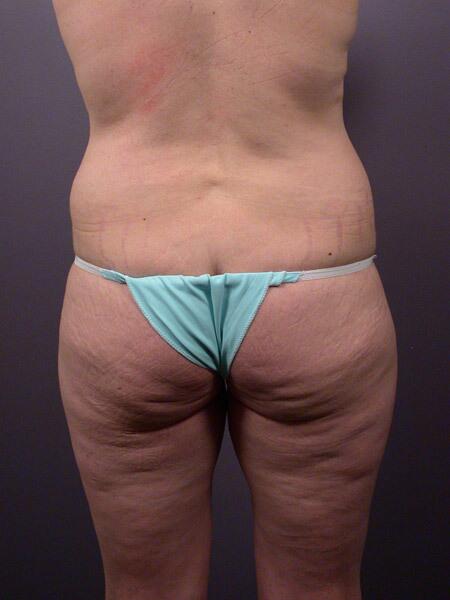 Liposuction Before & After Image