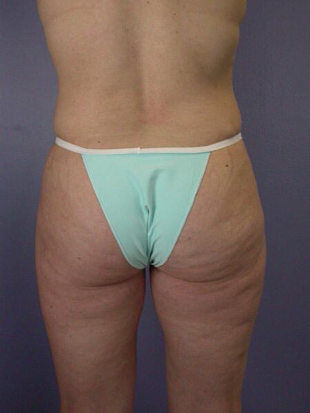 Liposuction Before & After Image