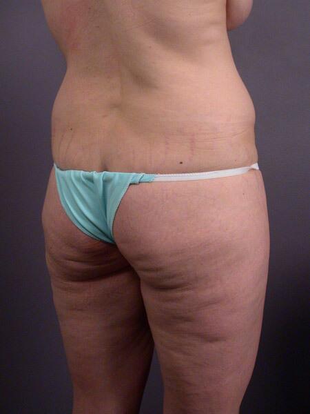 Liposuction Before & After Image