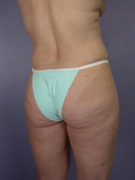 Liposuction Before & After Image