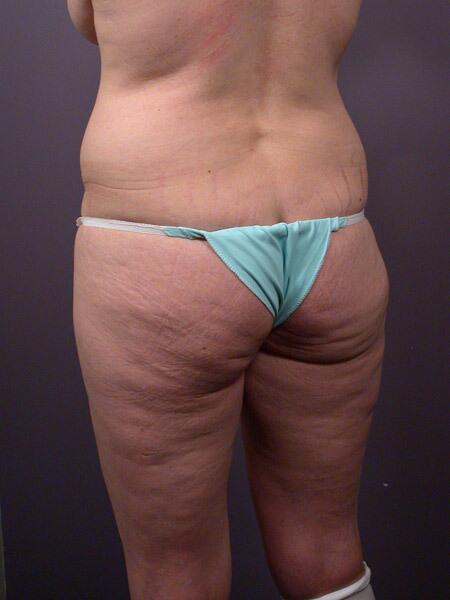 Liposuction Before & After Image