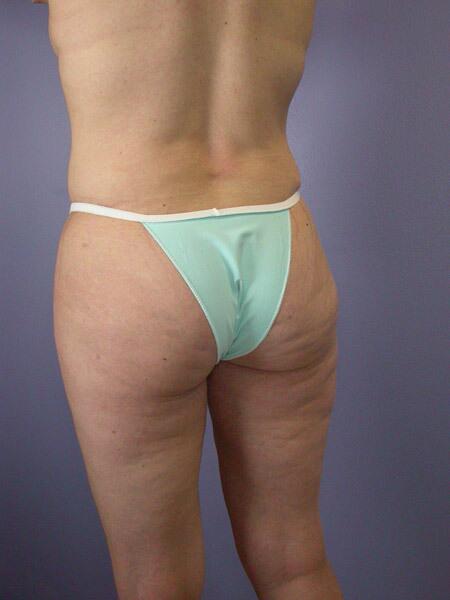 Liposuction Before & After Image