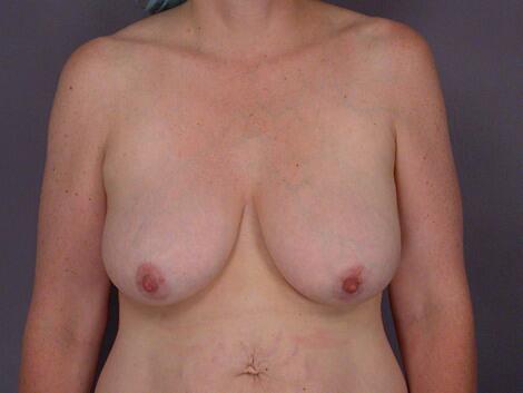 Liposuction Before & After Image