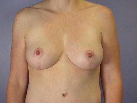 Liposuction Before & After Image