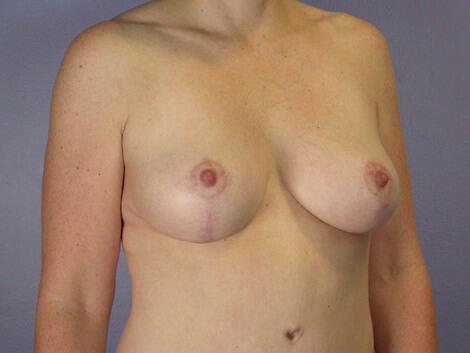 Liposuction Before & After Image