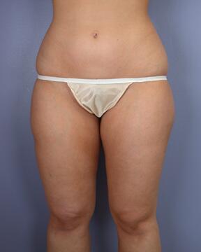 Liposuction Before & After Image