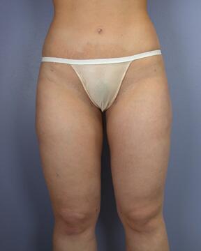 Liposuction Before & After Image