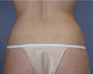 Liposuction Before & After Image