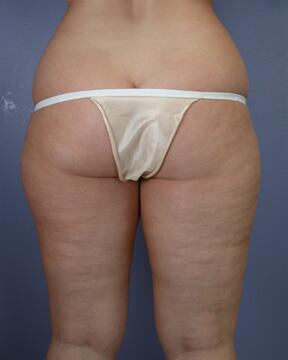 Liposuction Before & After Image