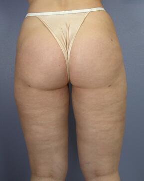 Liposuction Before & After Image