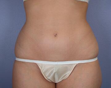 Liposuction Before & After Image