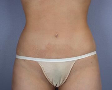 Liposuction Before & After Image