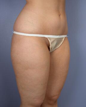 Liposuction Before & After Image