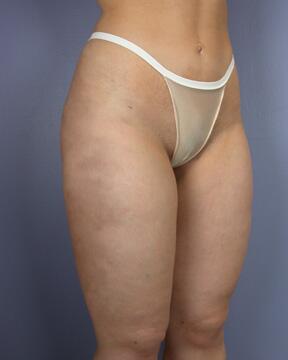 Liposuction Before & After Image