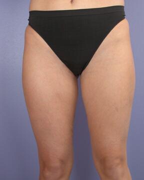 Liposuction Before & After Image