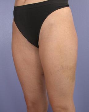 Liposuction Before & After Image