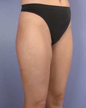 Liposuction Before & After Image