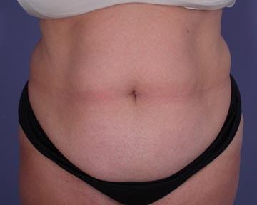 Liposuction Before & After Image