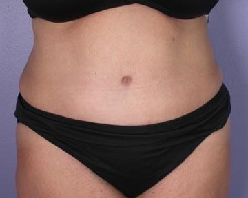 Liposuction Before & After Image