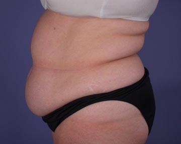 Liposuction Before & After Image