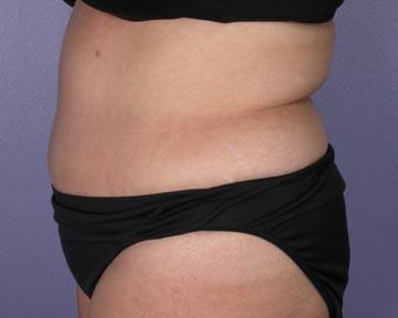 Liposuction Before & After Image