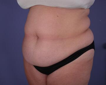 Liposuction Before & After Image