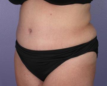 Liposuction Before & After Image