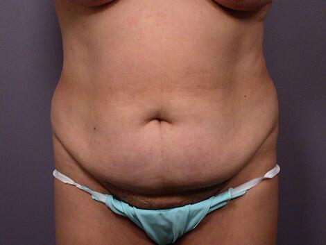 Liposuction Before & After Image