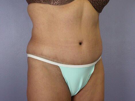 Liposuction Before & After Image