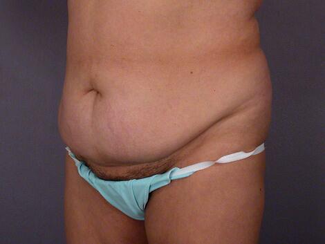 Liposuction Before & After Image