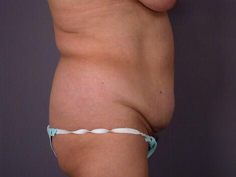 Liposuction Before & After Image