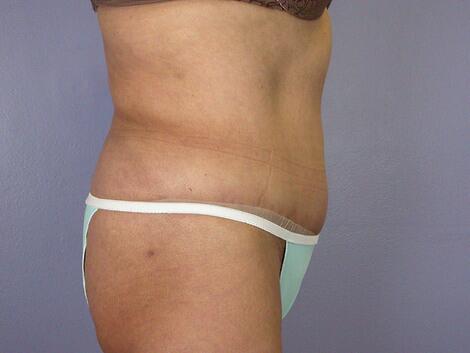 Liposuction Before & After Image