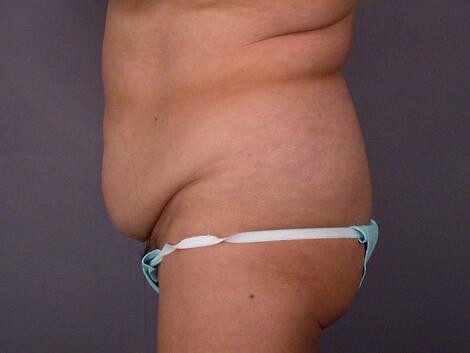 Liposuction Before & After Image