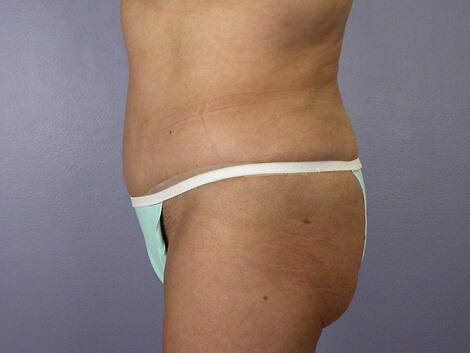 Liposuction Before & After Image