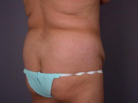 Liposuction Before & After Image