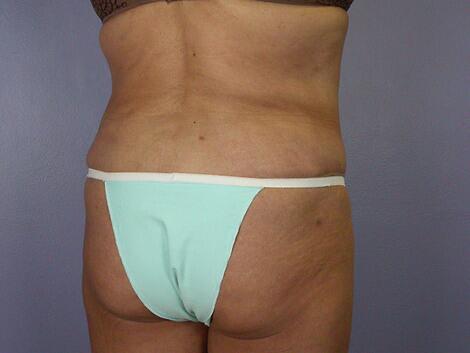 Liposuction Before & After Image