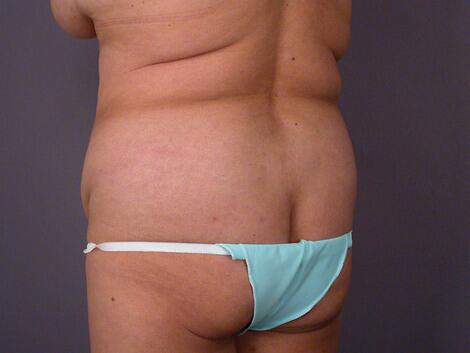 Liposuction Before & After Image